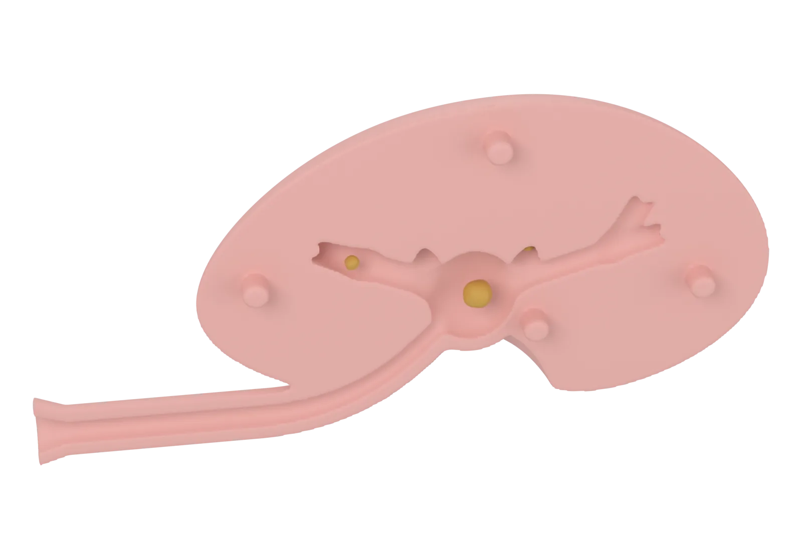Render of the posterior half lying open, with the ureter, renal pelvis and calyces cut into its face, a large stone in the pelvis and smaller stones in two calyces.